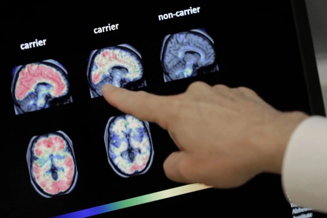 Un médico observa escáneres cerebrales PET (tomografia por emisión de positrones) en el Banner Alzheimers Institute de Phoenix, Arizona, el 14 de agosto de 2018. (Matt York/Archivo AP)