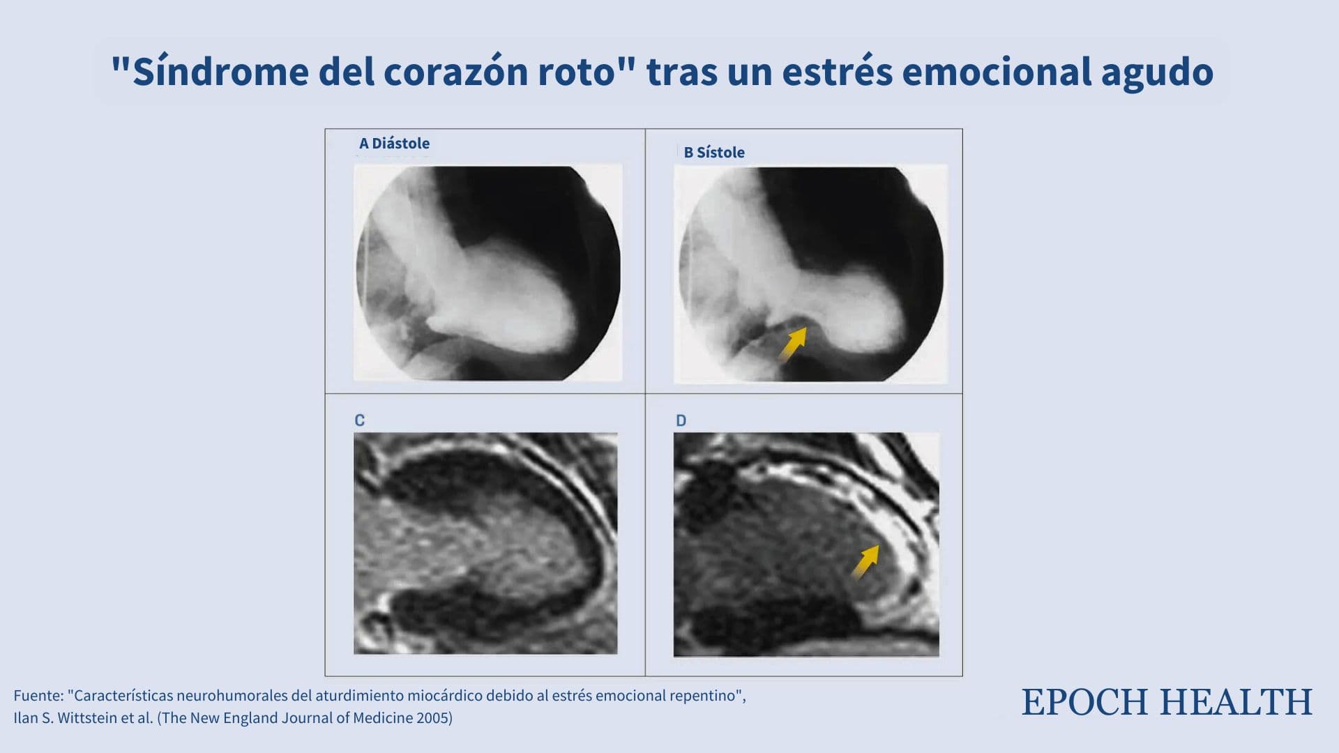 Los paneles A y B muestran que durante el síndrome del corazón roto, partes del corazón dejan de contraerse, pero siguen siendo viables. El panel C confirma que el músculo cardíaco en estas áreas está sano y puede recuperarse. El panel D, a modo de comparación, muestra el daño permanente en el músculo cardíaco causado por un ataque al corazón. (Cortesía de The New England Journal of Medicine ©2005)