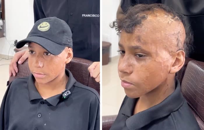 Niño de 12 años recupera su "cabello" tras años de sufrir graves quemaduras: ¡Mire cómo se ve!