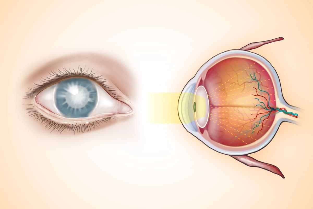 Una lente opaca causada por cataratas dispersa la luz, lo que hace que la visión se vea borrosa o nublada. Ilustración de (The Epoch Times, Shutterstock).