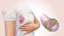 Cáncer de mama: El segundo tipo de cáncer más común en las mujeres y sus primeros síntomas