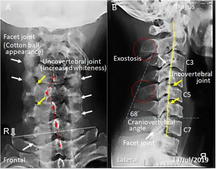 Prevención de la progresión del cuello de texto en un hombre joven: Informe de un caso. (Informes de Casos de Radiología. 2022;17(3):978-982. https://doi.org/10.1016/j.radcr.2021.12.053, bajo licencia CC BY 4.0).
