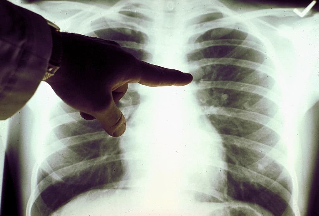 Primer plano de una radiografía de pulmón de un fumador, en una foto sin fecha. (Sociedad Americana del Cáncer vía Getty Images).

