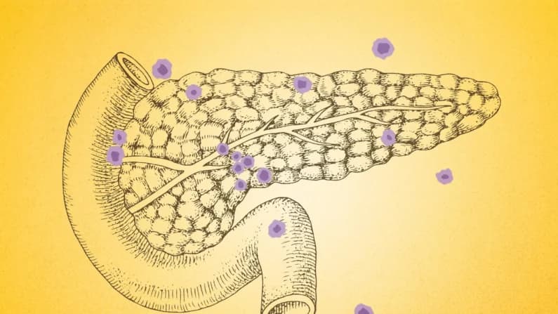 7 señales silenciosas del cáncer de páncreas que casi nadie nota
