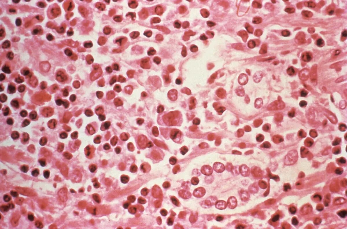 Un estudio micrográfico del tejido hepático de un paciente con síndrome pulmonar por hantavirus (HPS) en esta foto sin fecha obtenida por Reuters, el 6 de julio de 2017. (Centros para el Control y la Prevención de Enfermedades/Reuters)