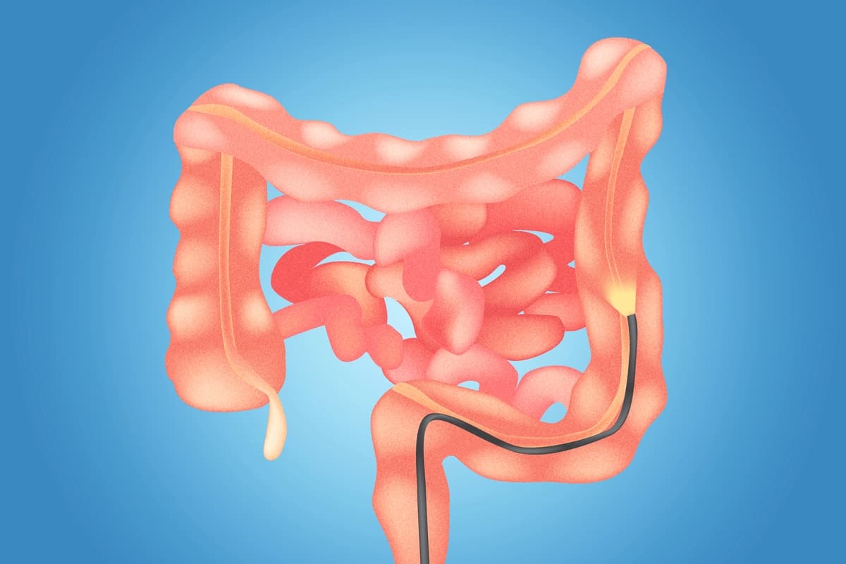 Una sola sigmoidoscopia reduce el riesgo de cáncer colorrectal por más de 20 años. (The Epoch Times/Shutterstock).