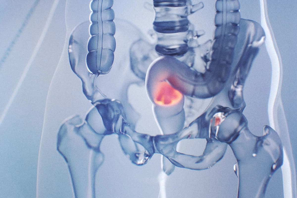 Aumenta el cáncer de recto mortal en adultos jóvenes; síntomas silenciosos que pasan desapercibidos. (3dMediSphere/Shutterstock).