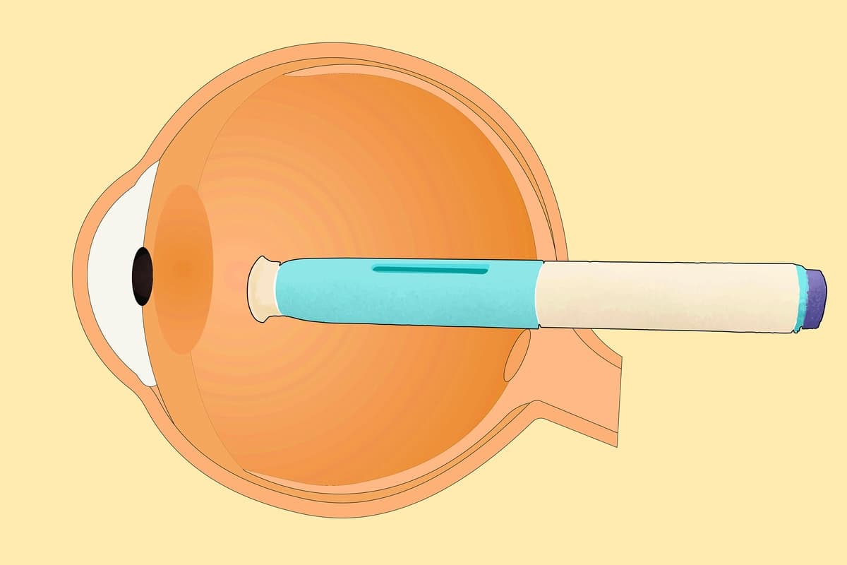 Revelan que los medicamentos para la migraña podrían reducir el riesgo de glaucoma: Estudio. (Illustration by The Epoch Times, Shutterstock).