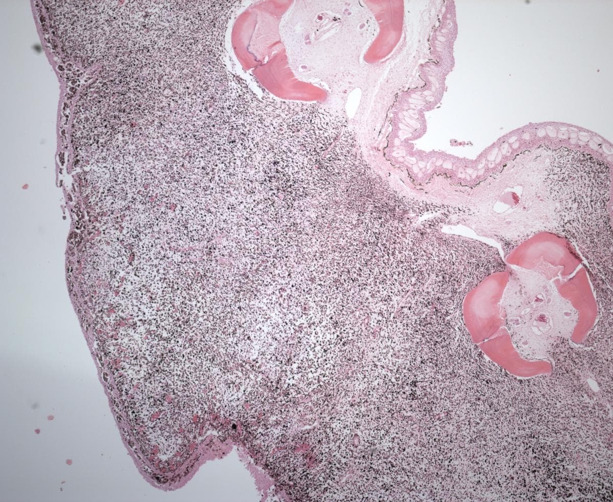Fotomicrografía que muestra un melanoma en una aleta de un bagre marrón. En la parte superior derecha se observa la piel normal (epidermis). La epidermis presenta células grandes y transparentes, así como una capa de melanocitos normales a lo largo de la membrana basal de la epidermis, que es donde se encuentran normalmente. La mayor parte del resto del tejido está compuesta por melanocitos neoplásicos que invaden tanto la epidermis como las áreas dérmicas y subdérmicas. (Servicio Geológico de Estados Unidos)