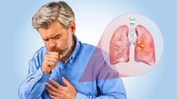 Cáncer de pulmón: El cáncer más mortal y sus principales causas