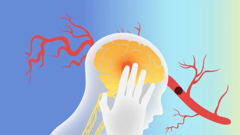 Estimular el nervio vago podría ayudar en la recuperación de un accidente cerebrovascular