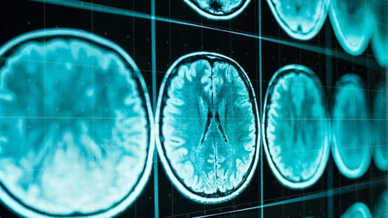 ¿Por qué se tarda tanto en diagnosticar la demencia?