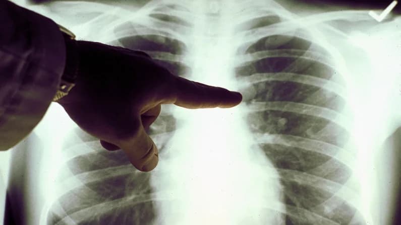 El agresivo cáncer de pulmón que suele pasar desapercibido hasta que es demasiado tarde