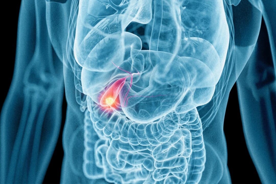 Los cálculos biliares causan un dolor repentino e intenso en la parte superior derecha del abdomen, a menudo acompañado de náuseas y vómitos. (3dMediSphere/Shutterstock)