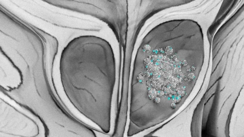 Detectan microplásticos en 9 de cada 10 muestras de cáncer de próstata en un estudio piloto