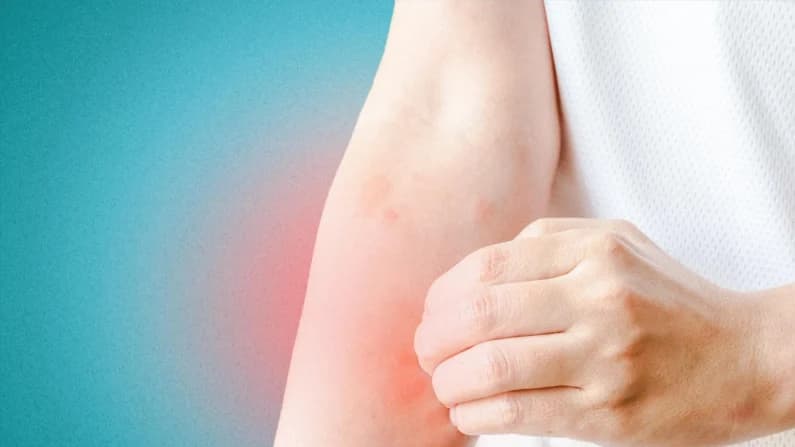 Urticaria, eczema y herpes zóster: cómo la medicina tradicional china alivia los problemas de piel