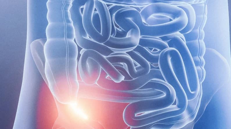 Extirpación del apéndice se asocia con mayor riesgo de padecer Alzheimer