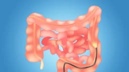 Una sola sigmoidoscopia reduce el riesgo de cáncer colorrectal por más de 20 años