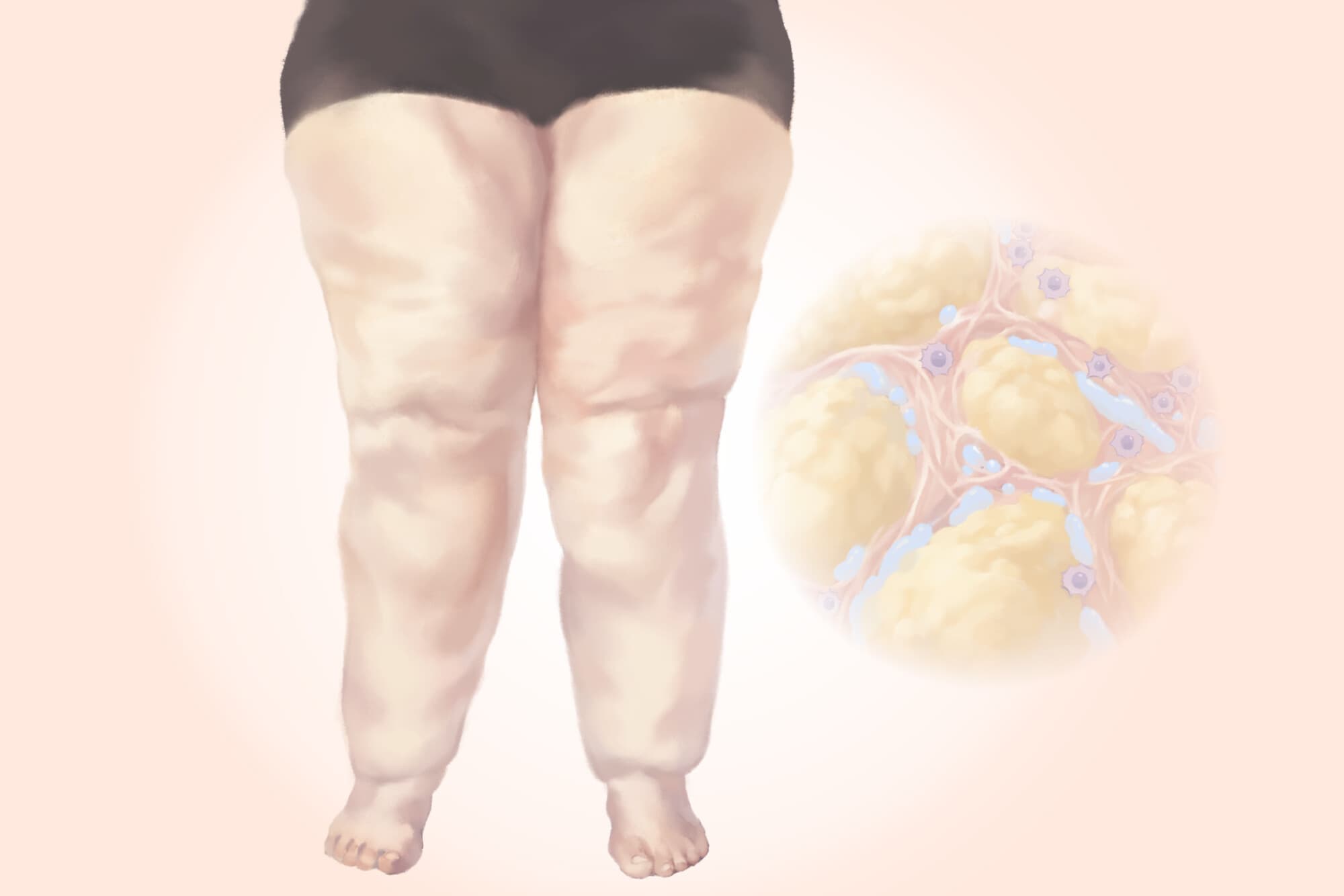 Lipedema: La acumulación dolorosa de grasa que se confunde con obesidad. (Ilustración de Ran/ The Epoch Times).