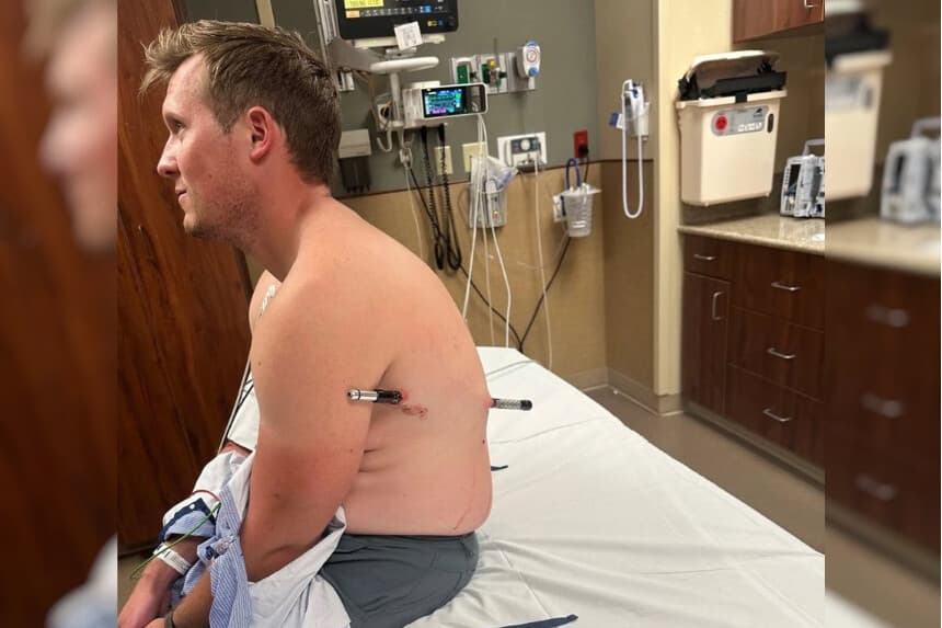 Fotografía tomada de la cuenta en X @DrEricDing del Dr. Eric Feigl-Ding donde aparece el senderista David Cifaldi, quien cayó sobre uno de sus bastones de senderismo y este atravesó el lateral de su torso. (EFE/ @DrEricDing)
