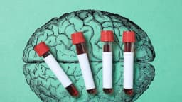 Un análisis de sangre puede detectar el Alzheimer, pero ¿quién debería hacérselo?