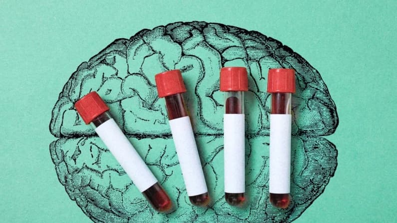Un análisis de sangre puede detectar el Alzheimer, pero ¿quién debería hacérselo?